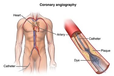 best hospital for angioplasty in narsinghpur, cost of heart stenting in narsinghpur