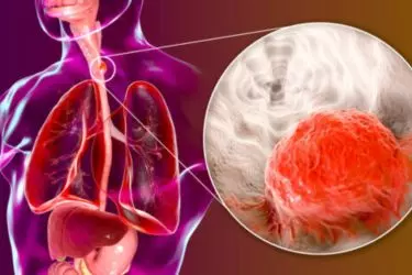 best hospital for treatment of food pipe cancer, best doctor for esophageal cancer surgery, cost of treatment of esophagus or cancer of food pipe, LNM Hospital narsinghpur madhya pradesh india
