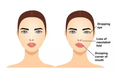 best hospital for facial palsy treatment in narsinghpur, best doctor for facial palsy treatment in narsinghpur, cost of facial palsy treatment in narsinghpur