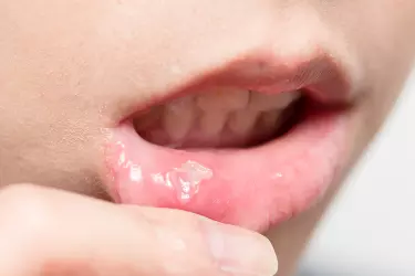best hospital for mouth cancer treatment in Narsinghpur, best doctor for mouth cancer treatment in Narsinghpur, cost of mouth cancer treatment in Narsinghpur