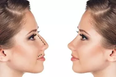 best hospital for septoplasty surgery in narsinghpur, best doctor for septoplasty surgery in narsinghpur, cost of septoplasty surgery in narsinghpur